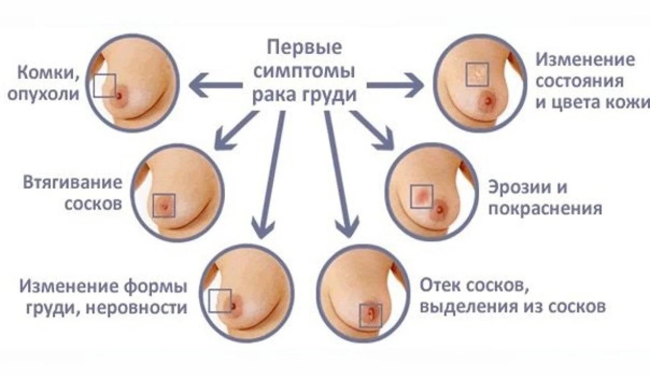 симптомы рака груди.jpg