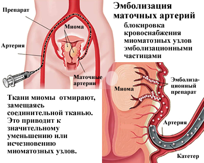 Диагностика и лечение фибромы матки в Нижнем Новгороде | ТОНУС ПРЕМИУМ